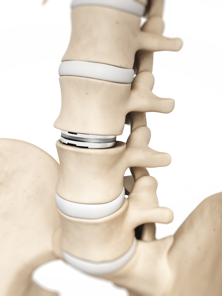 10 Best Practices to Keep Your Discs From Becoming Herniated: The Spine  Institute of Southeast Texas: Orthopedic Surgeons