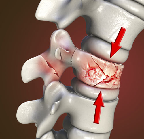 Spinal Fracture - Texas Back Institute