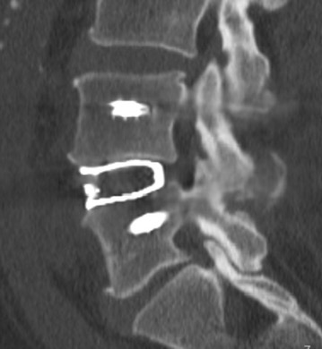 CT Scan of a patient with a 3D- printed patient specific interbody cage in the lumbar spine.