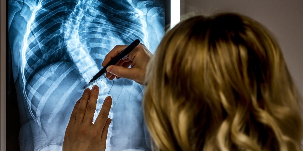 Xray of patient with scoliosis